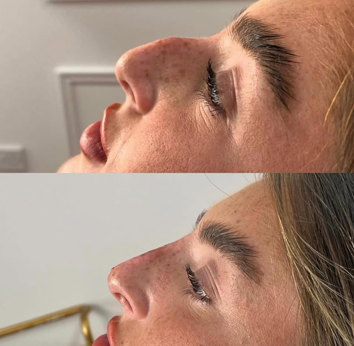 Dorsal Hump Correction Results